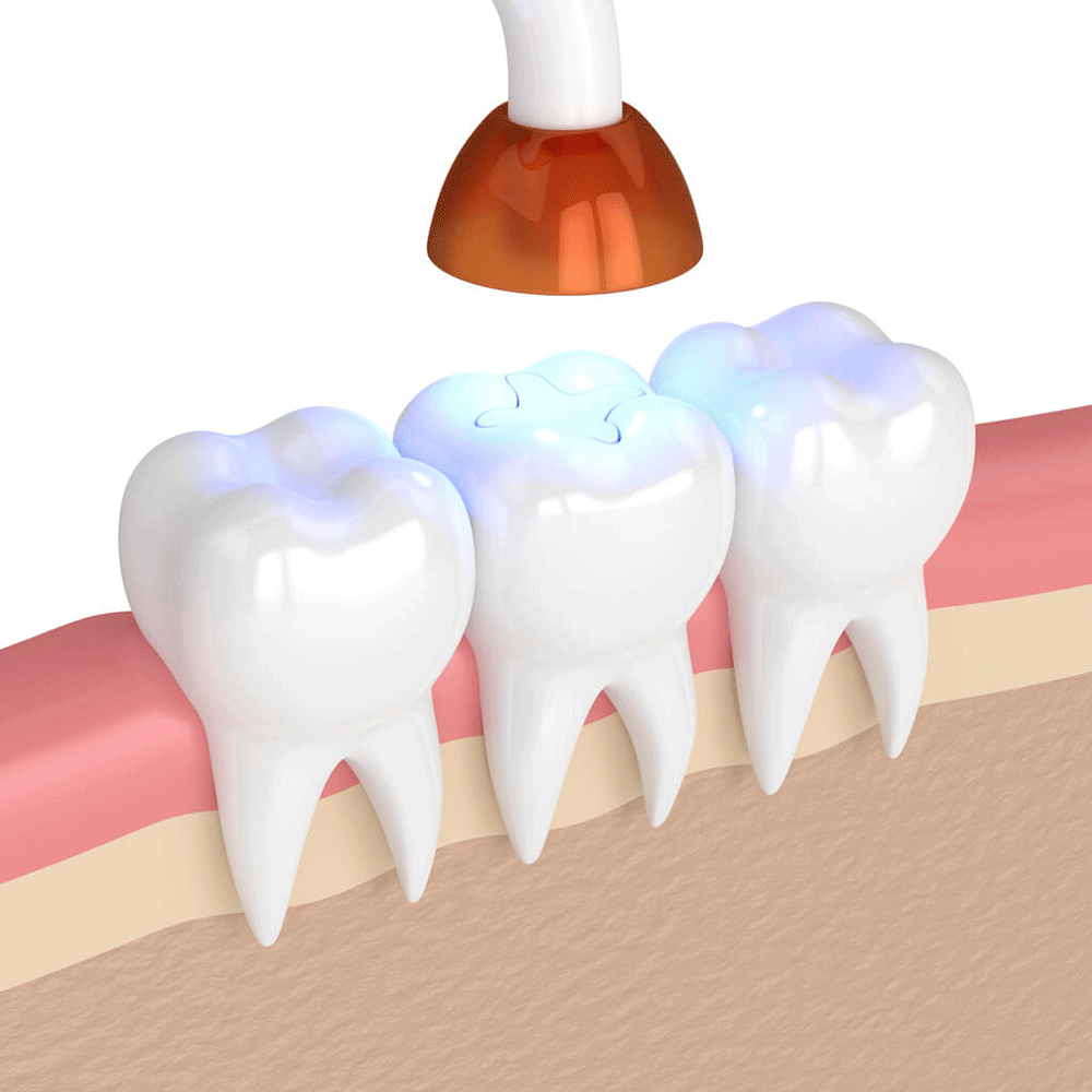 An image representing how a tooth is filled during a cavity filling